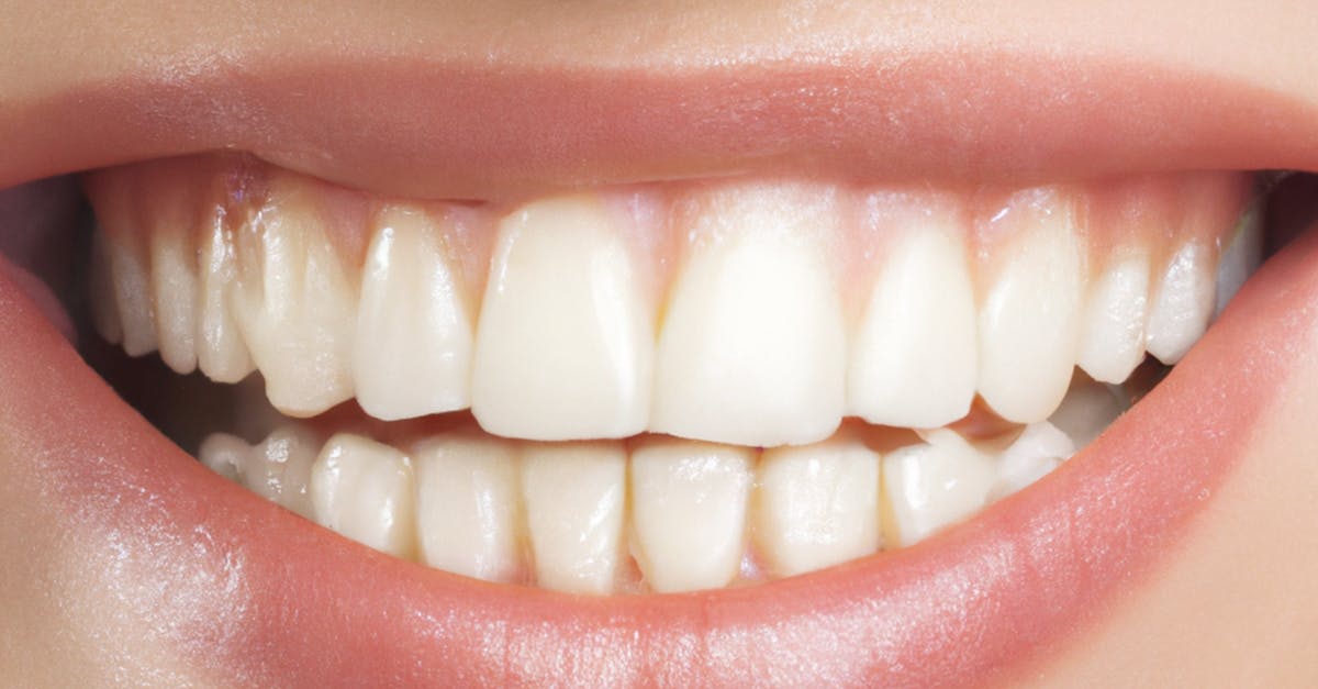 Clear aligner & Invisalign cost estimate: refinements + insurance (2026) | CalculaSite